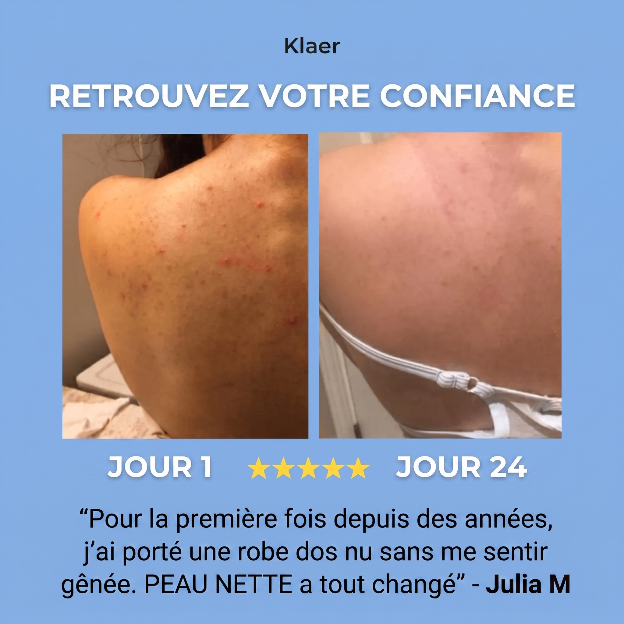PEAU NETTE SAVON TRAITANT ANTI-ACNÉ