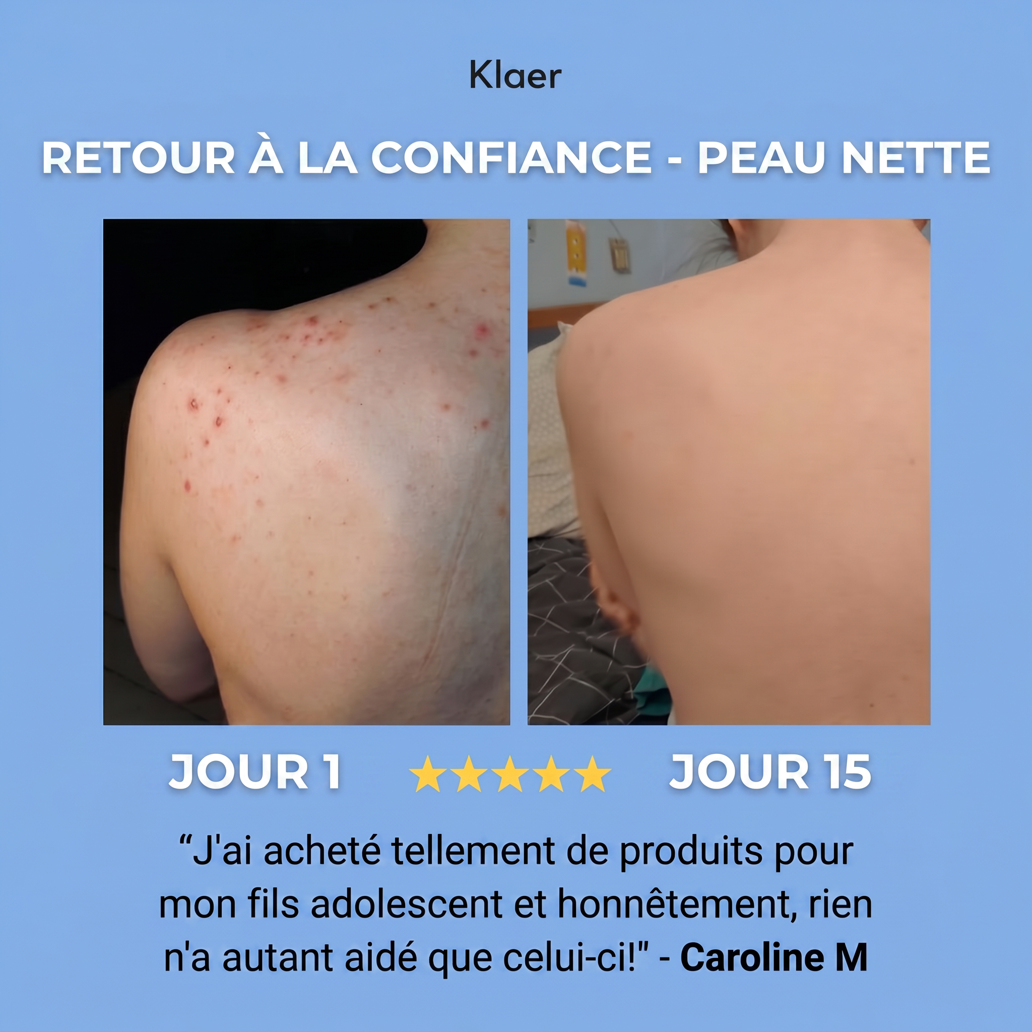 PEAU NETTE SAVON TRAITANT ANTI-ACNÉ